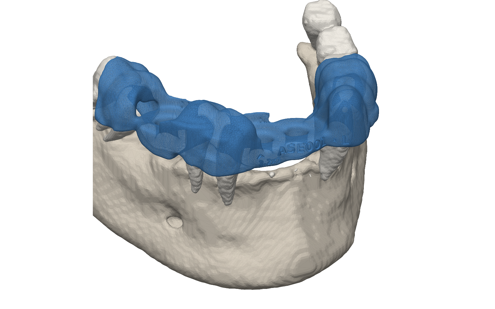 A blue surgical guide seated over a segmented lower jaw, showing drill sleeve openings and the case identifier engraved into the guide body.