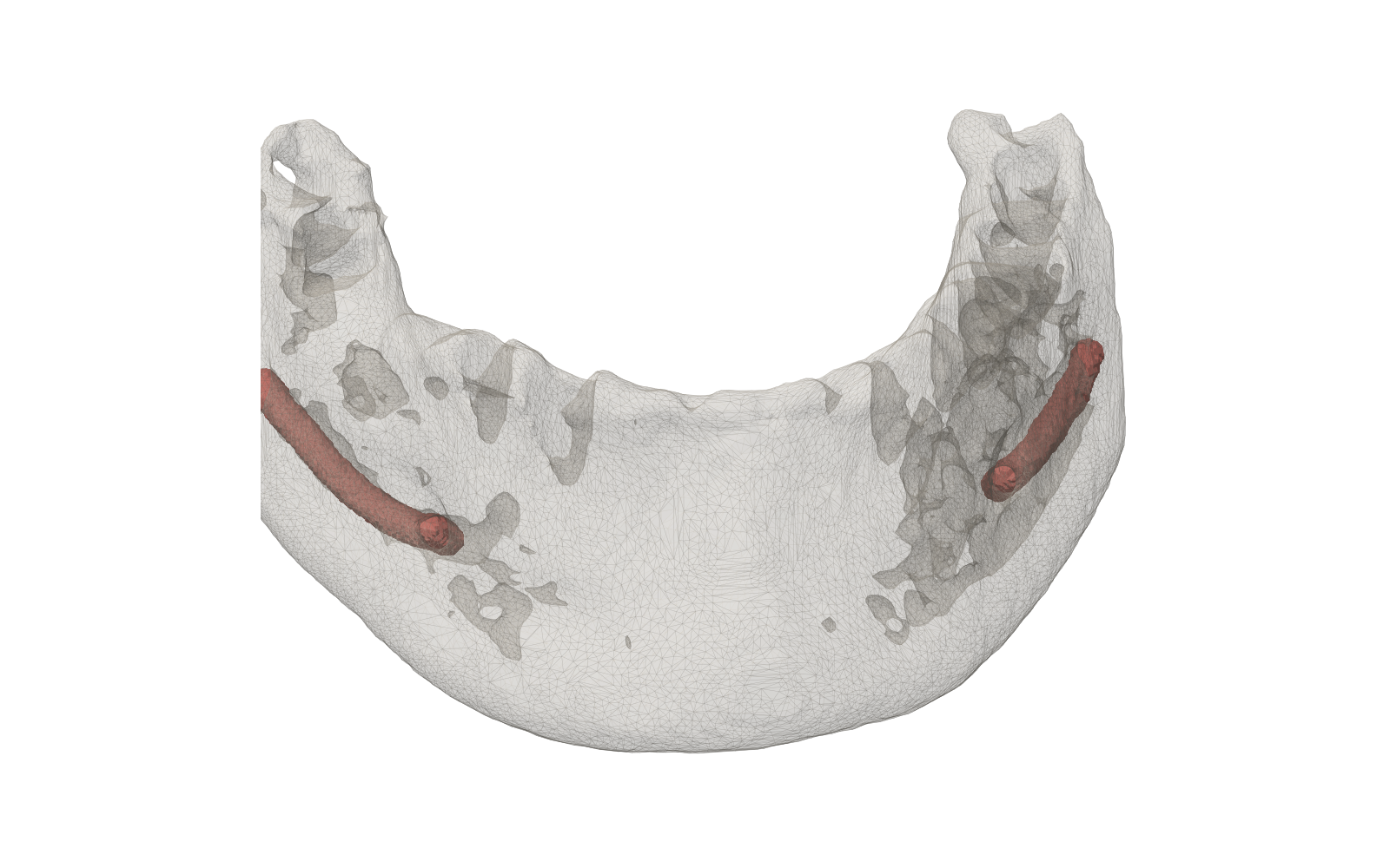 The inferior alveolar nerve canal traced through translucent mandibular bone, visible on both sides of the jaw.